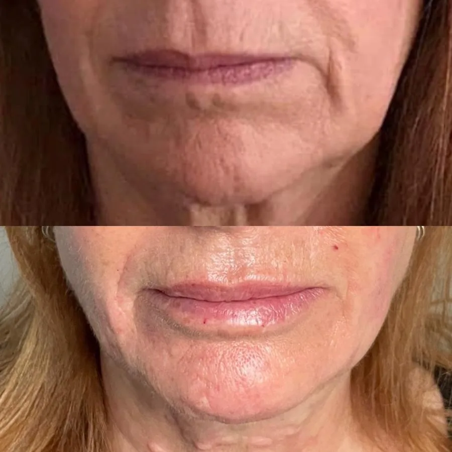Before lip and mouth-area dermal filler at Cosmetic Medicine