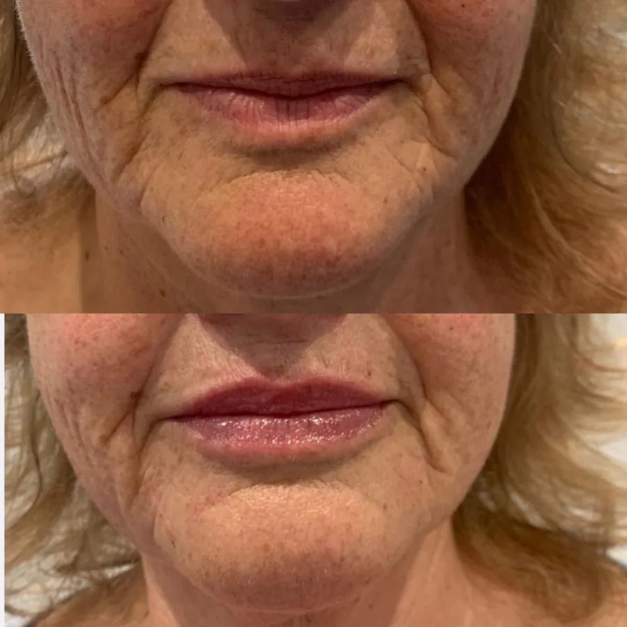 Before lip and mouth-area dermal filler at Cosmetic Medicine