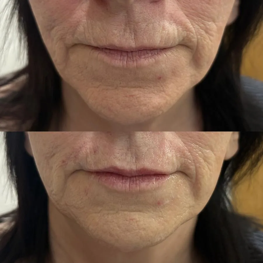 Before lip and mouth-area dermal filler at Cosmetic Medicine