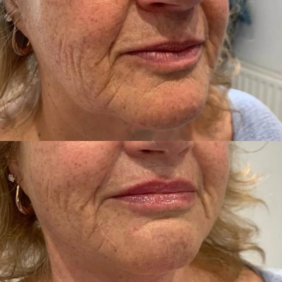 Before lip and mouth-area dermal filler at Cosmetic Medicine