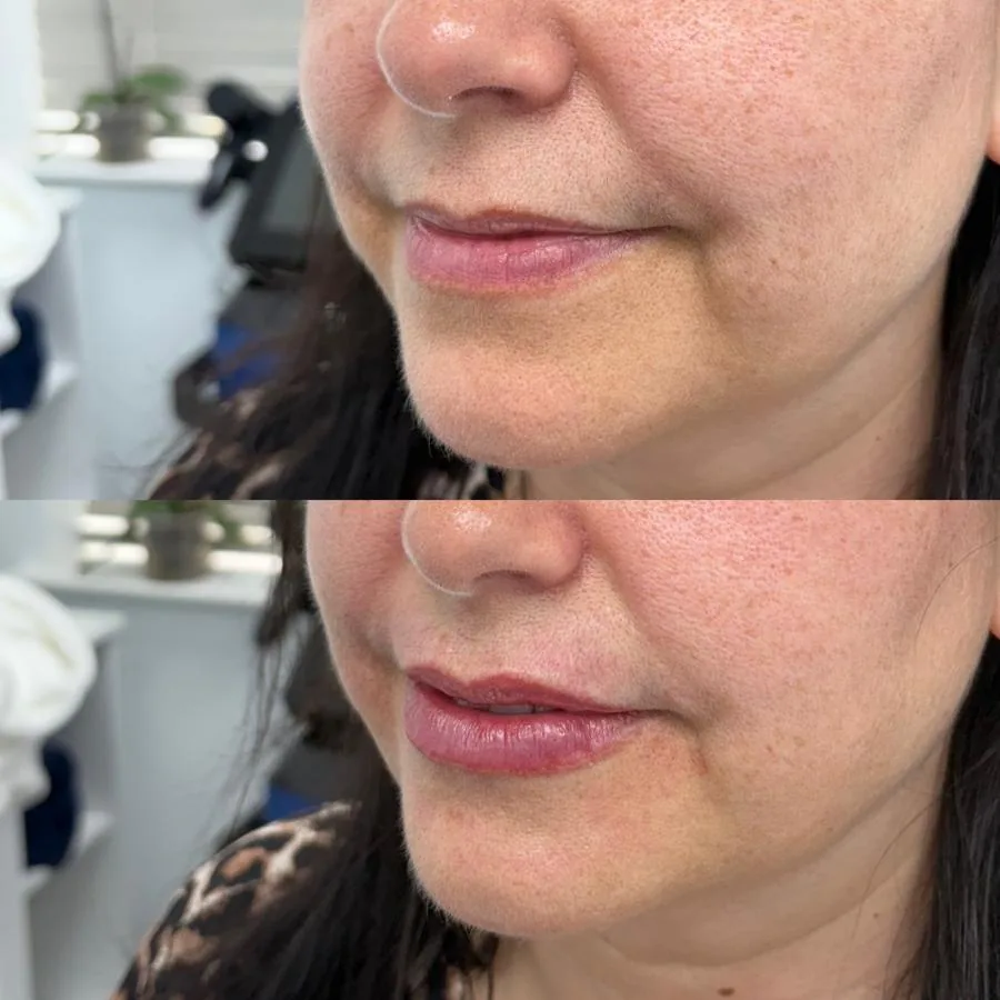 Before lip and mouth-area dermal filler at Cosmetic Medicine