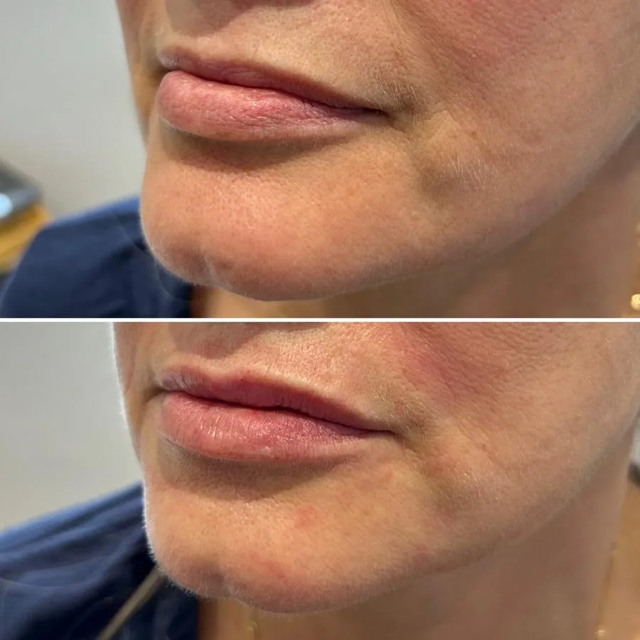 Before lip and mouth-area dermal filler at Cosmetic Medicine