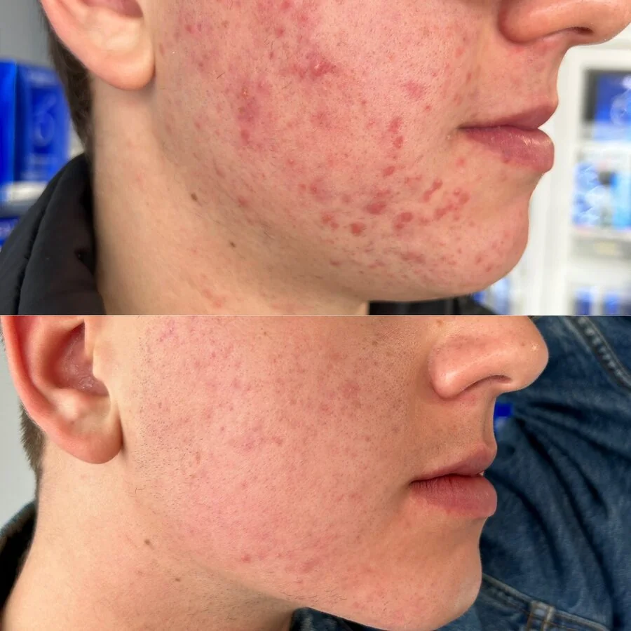 Acne treatment with chemical peels and ZO skincare — before and after, real Cosmetic Medicine patient