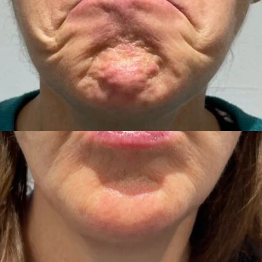 Chin and perioral rejuvenation — before and after, real Cosmetic Medicine patient