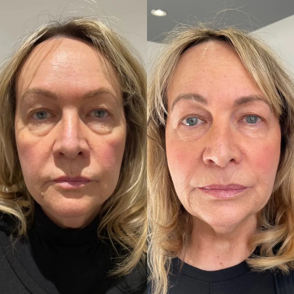 Full face rejuvenation, fresher and more rested — before and after, real Cosmetic Medicine patient
