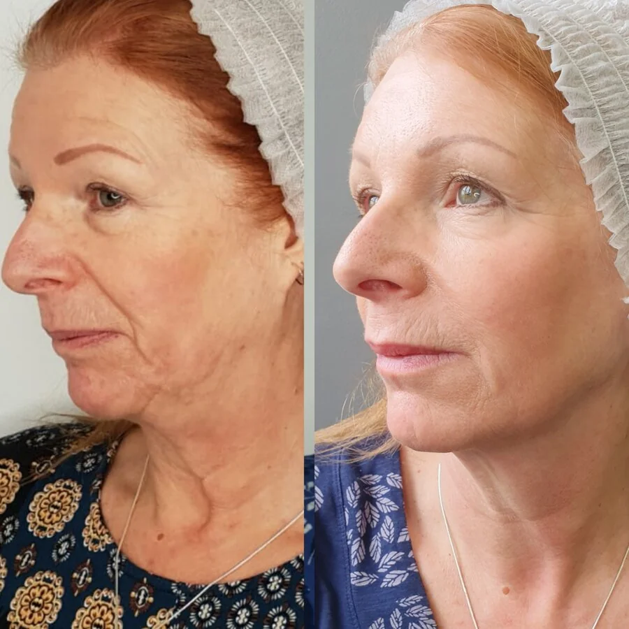 Full face profile rejuvenation — before and after, real Cosmetic Medicine patient