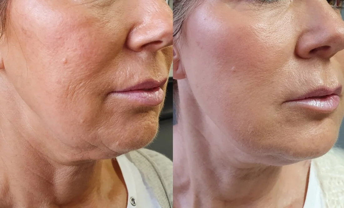 Jawline and lower face contouring — before and after, real Cosmetic Medicine patient