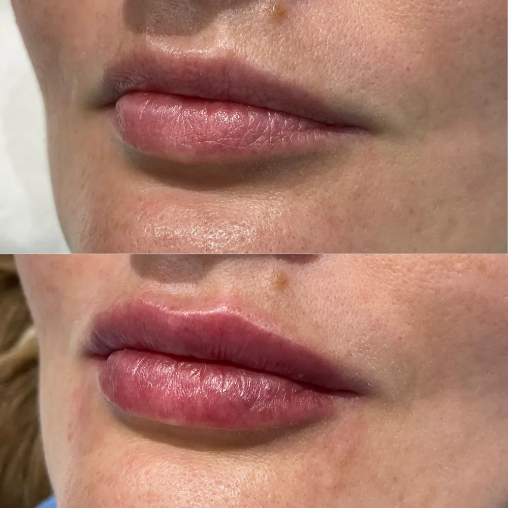 Lip definition — before and after, real Cosmetic Medicine patient