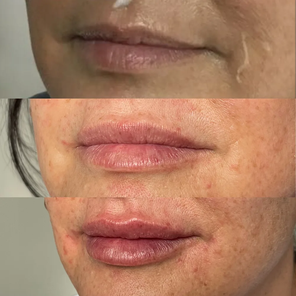 Lip hydration and shape — before and after, real Cosmetic Medicine patient
