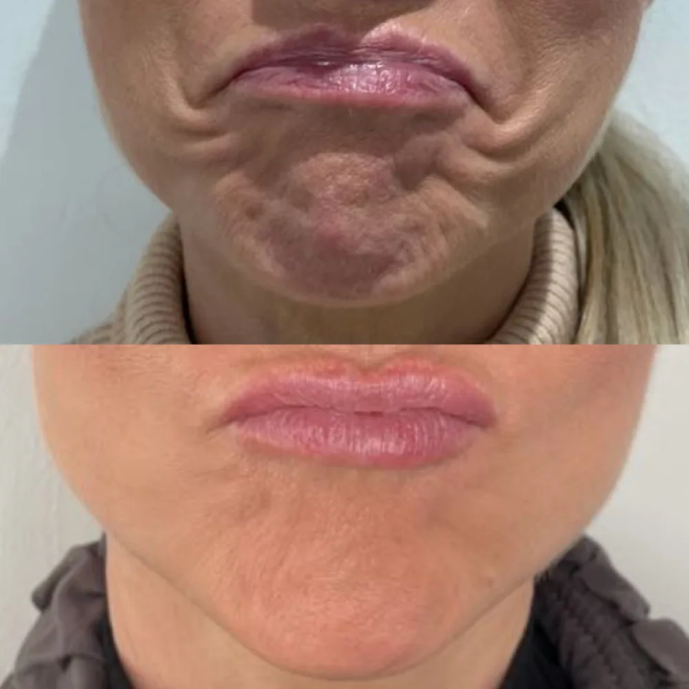 Lips and mouth corners — before and after, real Cosmetic Medicine patient