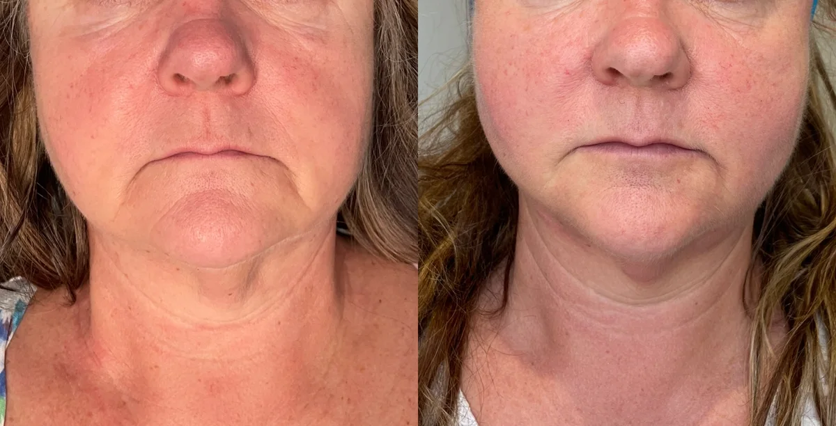 Lower face, jawline and neck — before and after, real Cosmetic Medicine patient