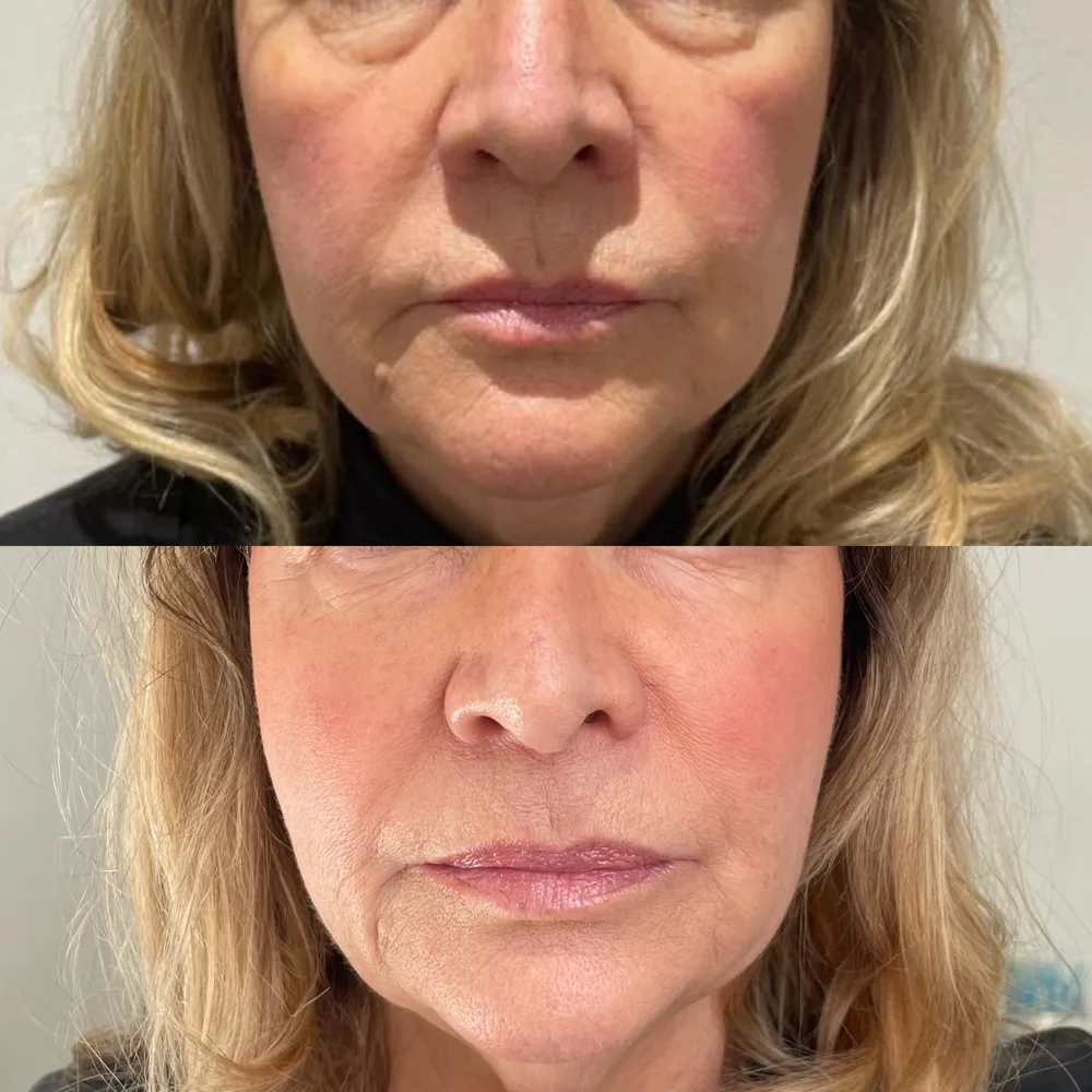 Lower face and mouth area — before and after, real Cosmetic Medicine patient