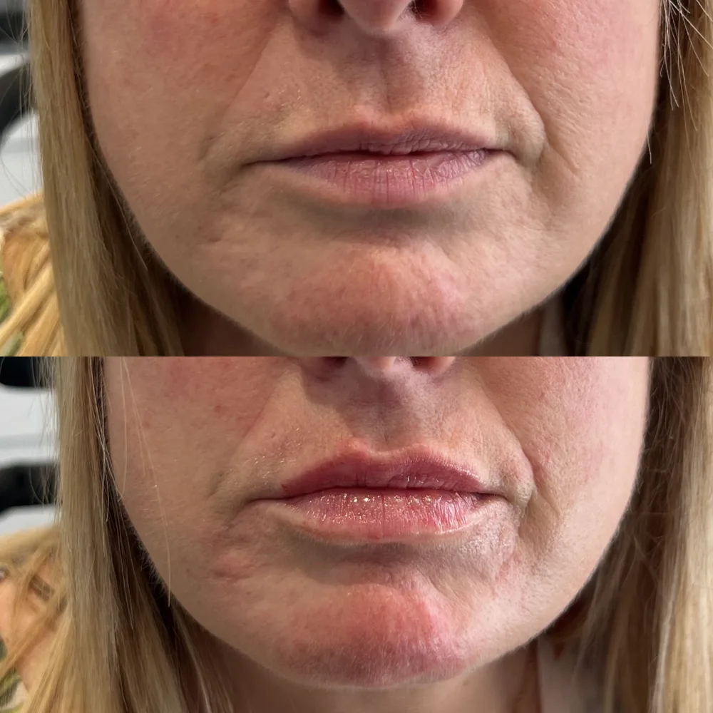 Natural lip volume — before and after, real Cosmetic Medicine patient