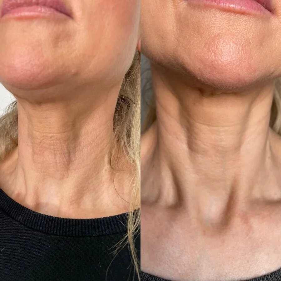 Neck rejuvenation — before and after, real Cosmetic Medicine patient