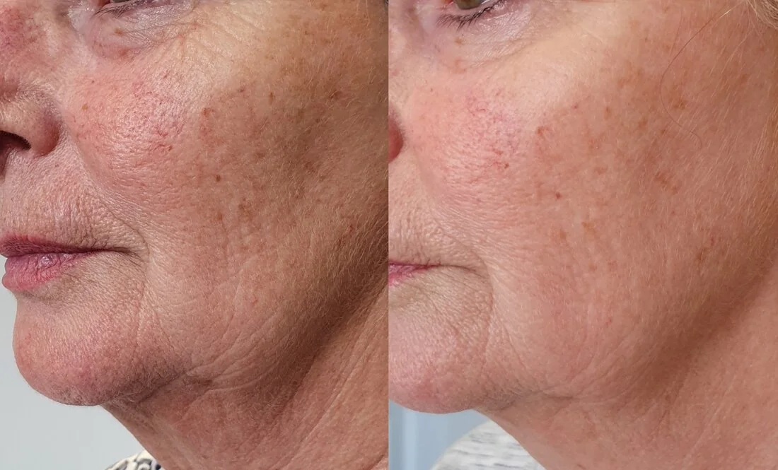 Pigmentation and skin texture treatment — before and after, real Cosmetic Medicine patient