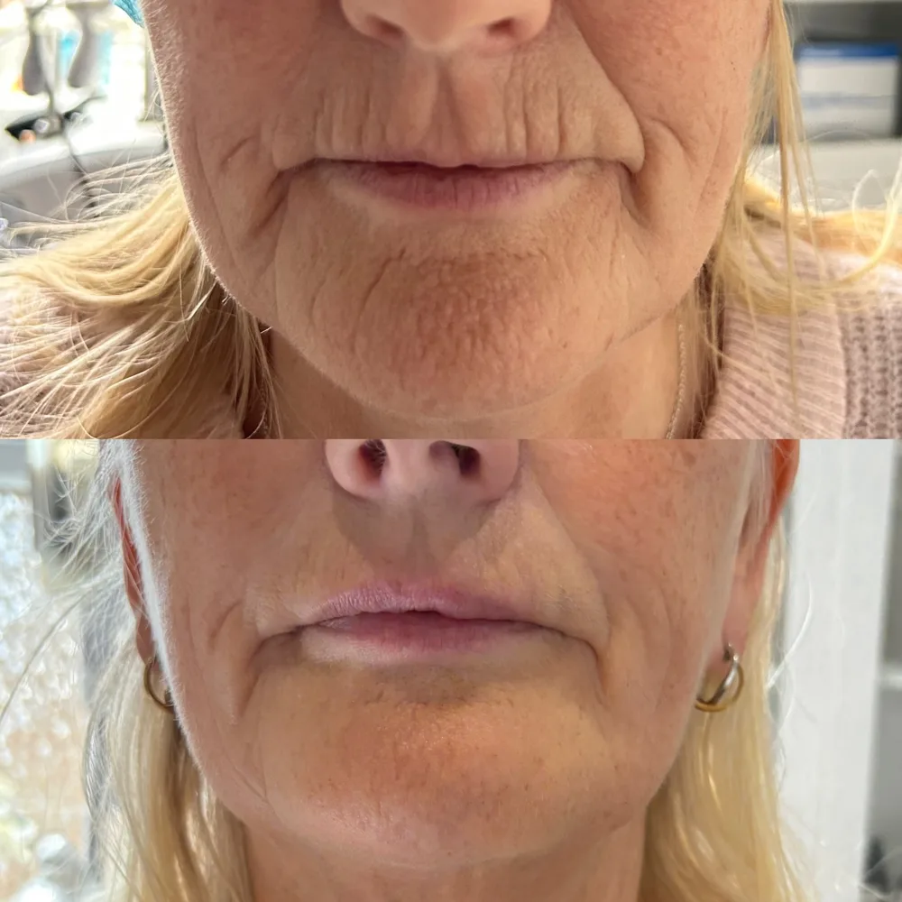 Smoker's lines softened — before and after, real Cosmetic Medicine patient